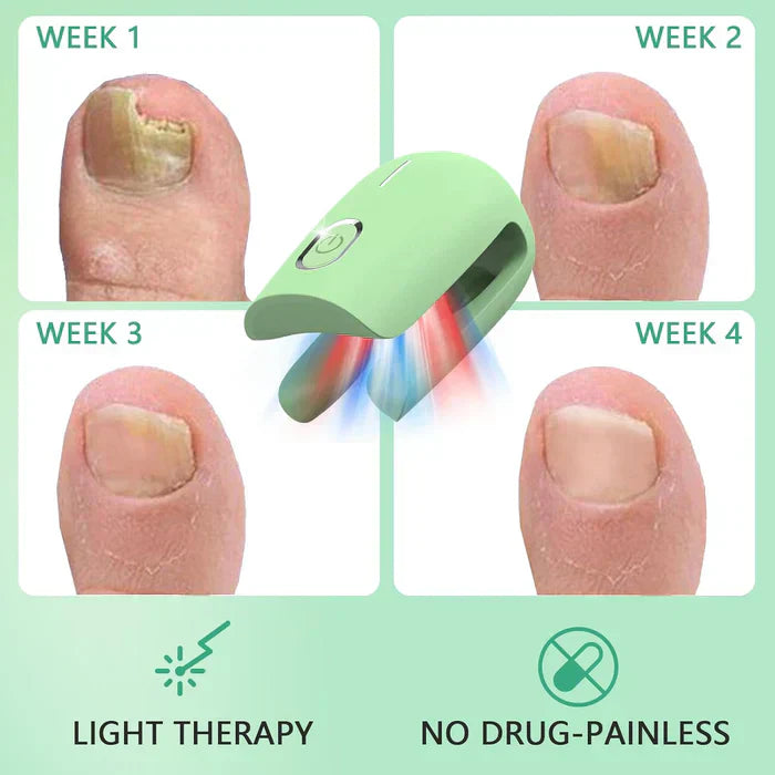Onychomycosis Treatment Device for Nail Fungus Removal