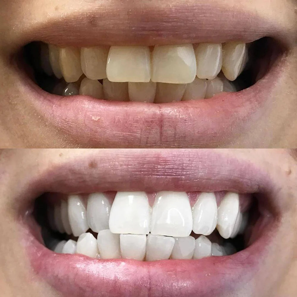 LumaLux — Instantly Boost Your Confidence with a Brighter, Radiant Smile