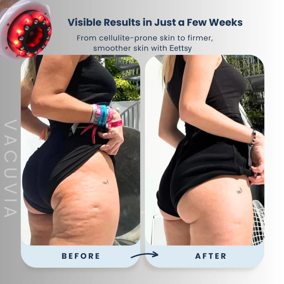 Vacuvia Electric Cellulite Massager for Body Firming & Toning