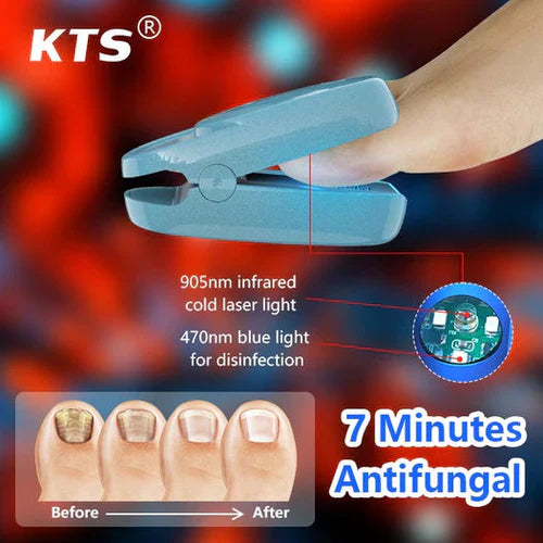 Nail Fungus Laser Treatment Device for Onychomycosis