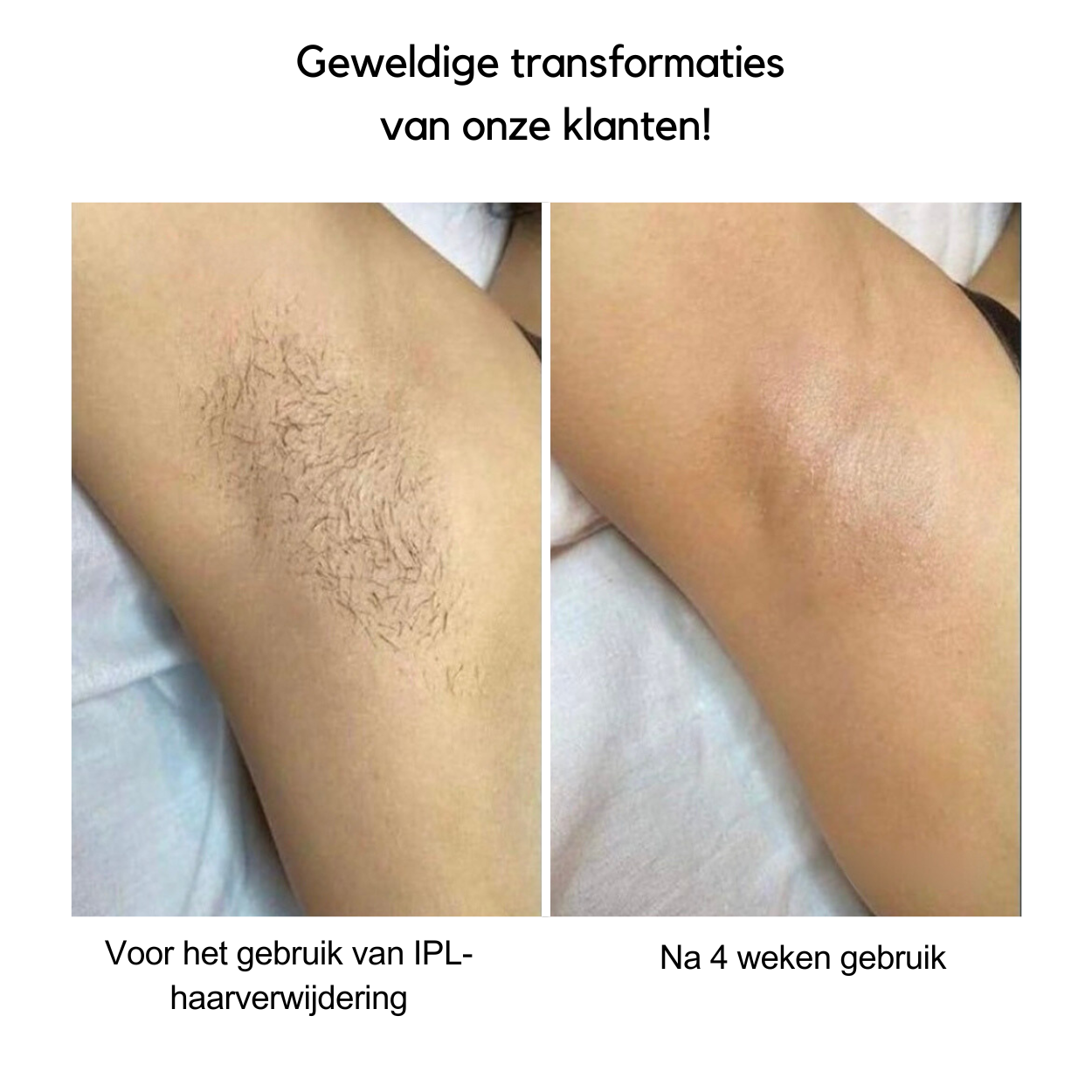 IPL Hair Removal Device for Quick Results and Smooth Skin