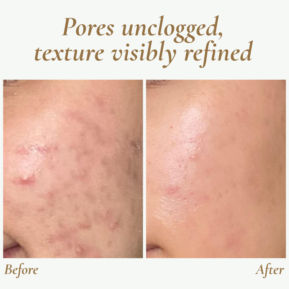 SkinPulse Ultrasonic Skin Scrubber for Deep Cleansing