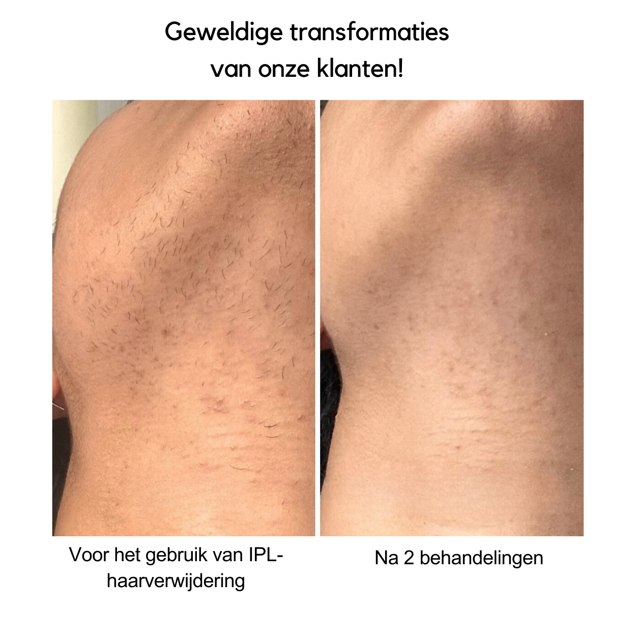 IPL Hair Removal Device for Quick Results and Smooth Skin