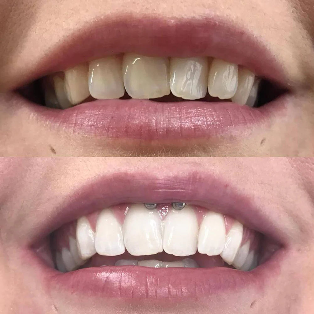 LumaLux — Instantly Boost Your Confidence with a Brighter, Radiant Smile