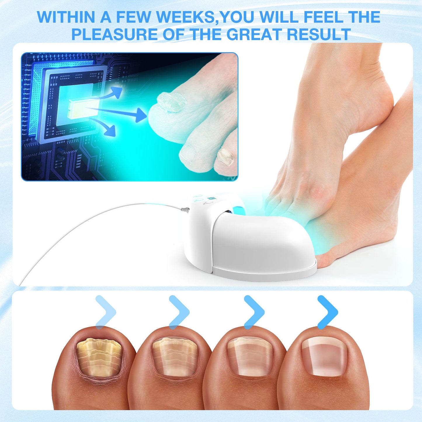 Home Device for Treating Nail Fungus on Multiple Toenails