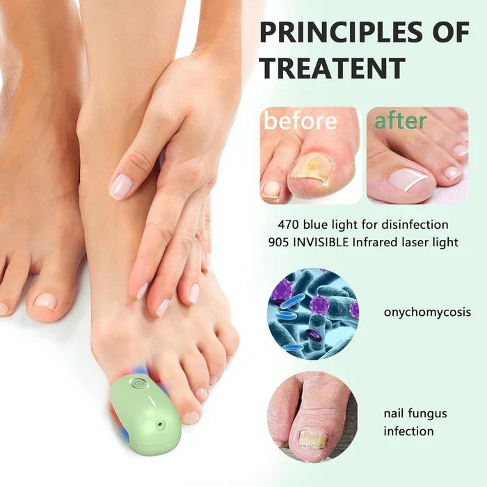 Laser Treatment Device for Toenail Fungus Therapy