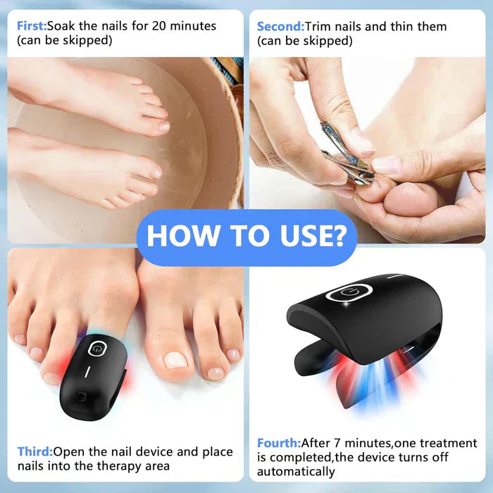 Laser Treatment Device for Toenail Fungus Therapy