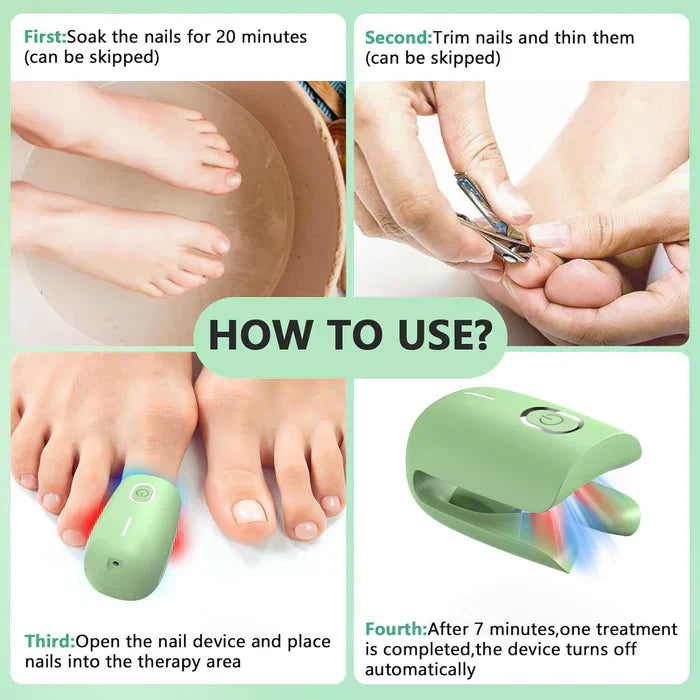Laser Treatment Device for Toenail Fungus Therapy