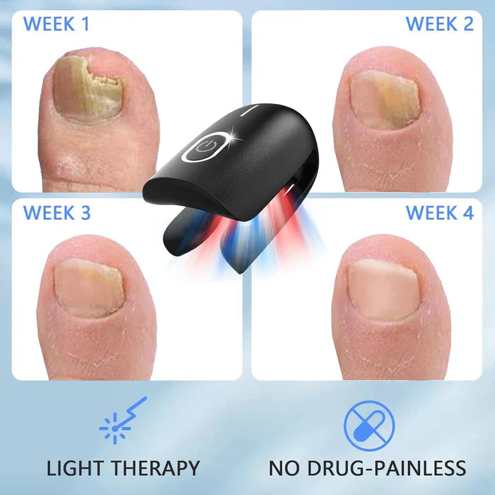 Laser Treatment Device for Toenail Fungus Therapy