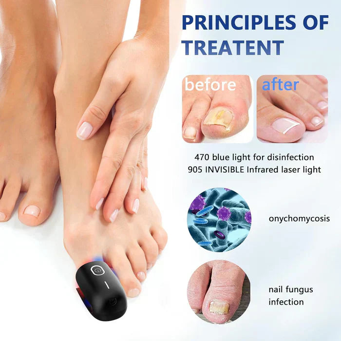 Laser Treatment Device for Toenail Fungus Therapy
