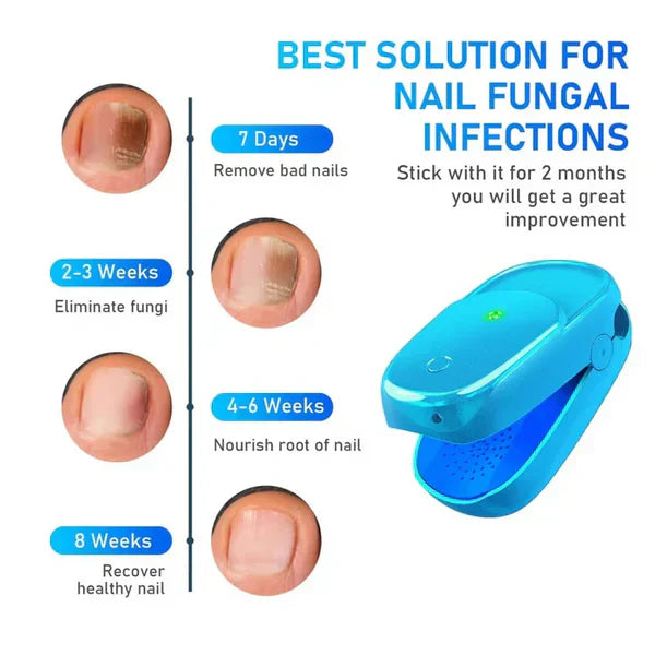 Nail Fungus Laser Treatment Device for Onychomycosis