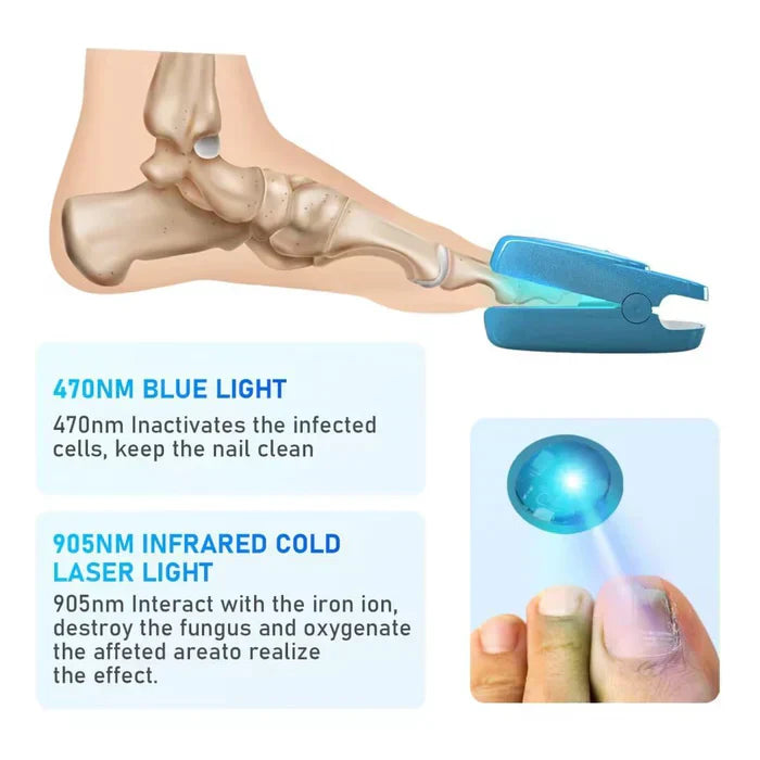 Nail Fungus Laser Treatment Device for Onychomycosis