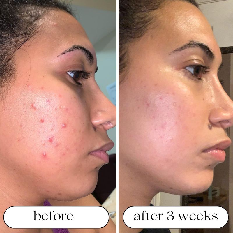 LED Light Therapy Device for At-Home Skin Treatment