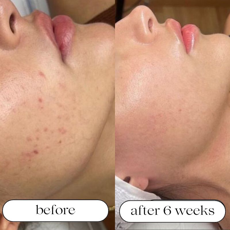 LED Light Therapy Device for At-Home Skin Treatment