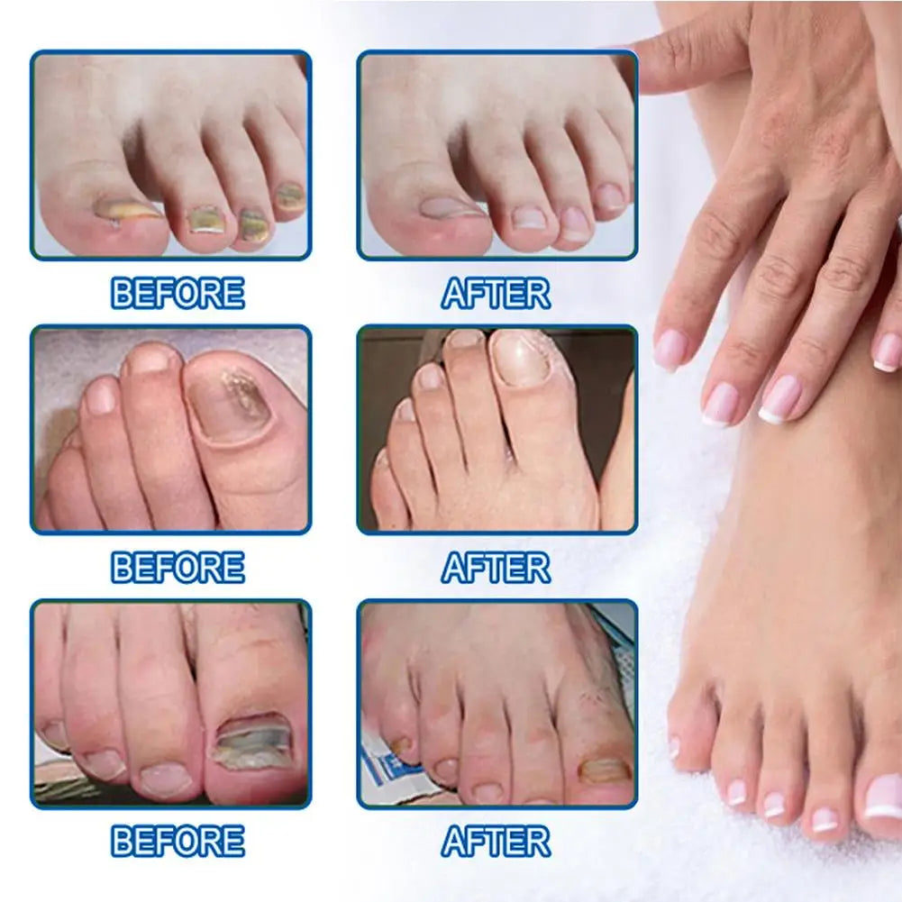 HealthyNail Fungal Nail Restoration Patches - Restore Clear, Healthy Nails Discreetly