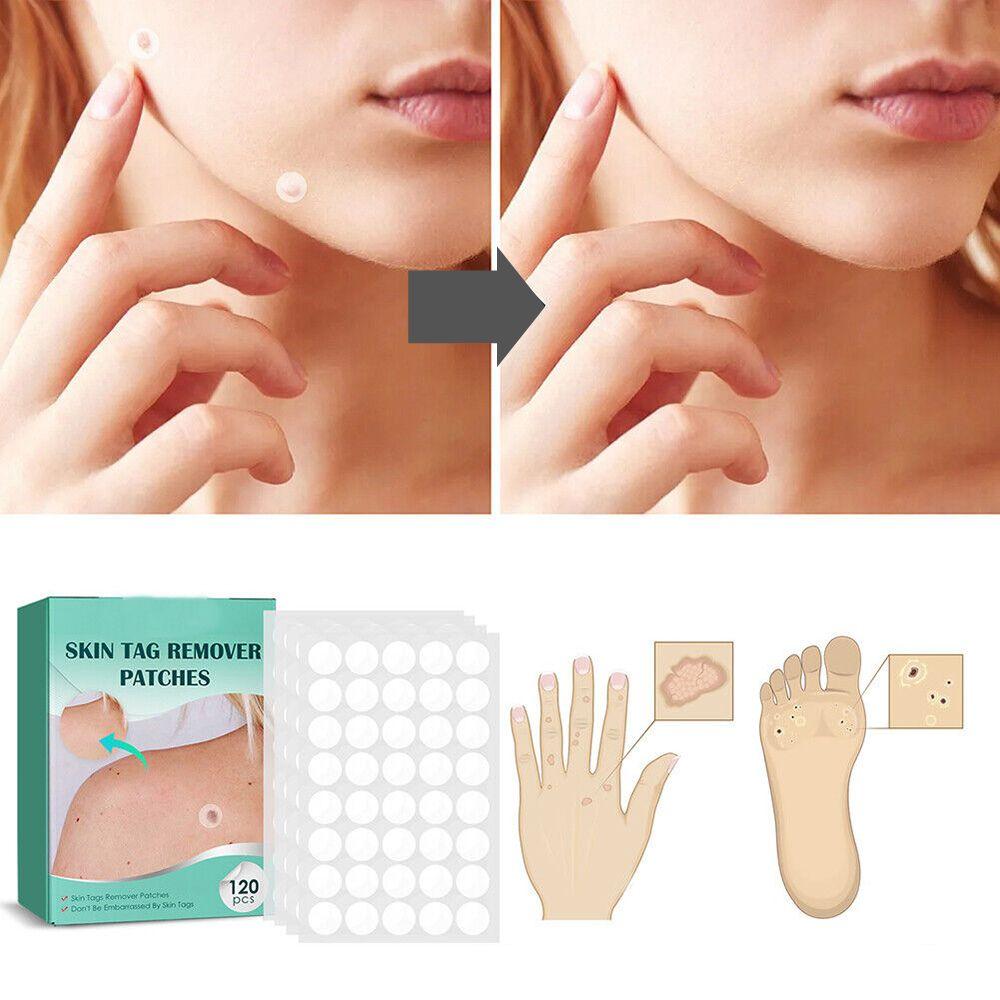 SkinClear - Patch for the removal of spots and warts