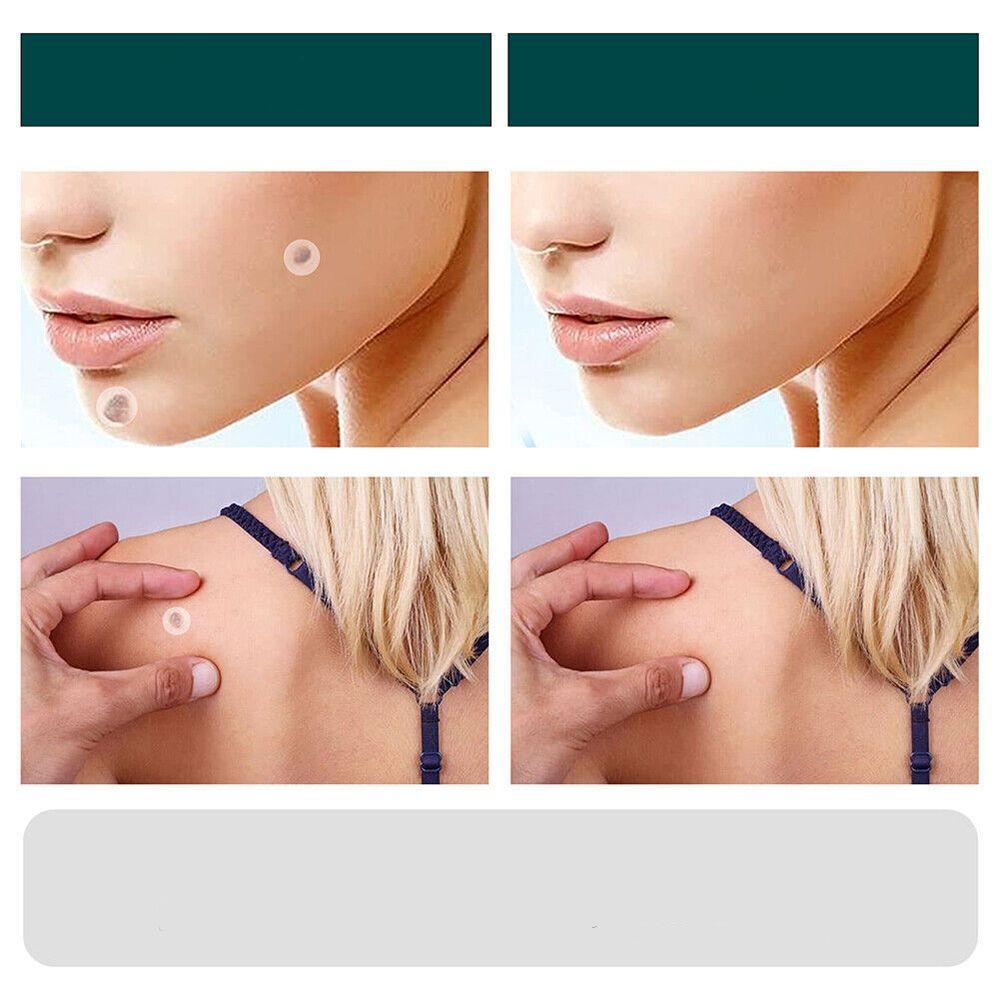 SkinClear - Patch for the removal of spots and warts