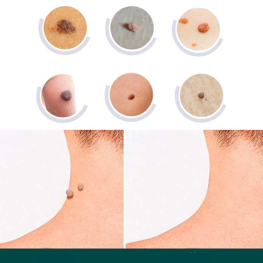 SkinClear - Patch for the removal of spots and warts