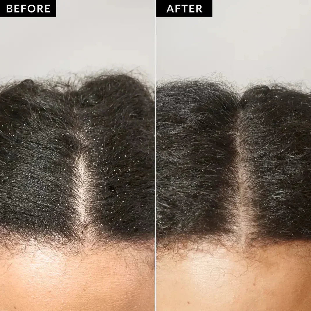 Dandruffree™ Scalp Detox Comb